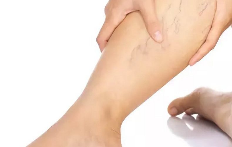 Новейший метод лечения варикоза: эффективность и безопасность лазерной терапии